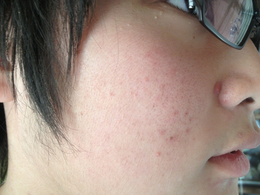 トリア・スキンパーフェクティングブルーライトを使って3ヶ月後の高校生男子の顔肌
